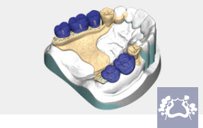 Exocad Module PartialCAD - perpetuel